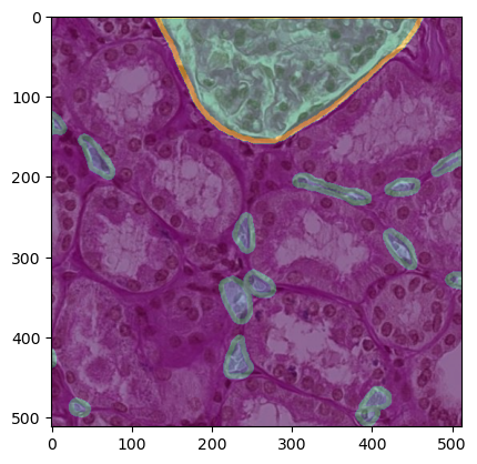Kidney tile with blood-vessel mask overlay